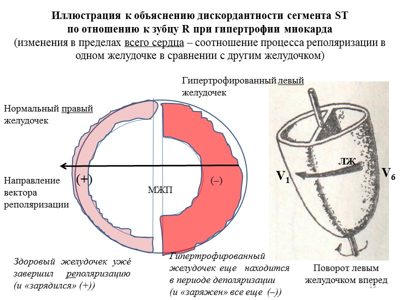 15 (+) (–) Направление вектора реполяризации Нормальный правый желудочек Гипертрофированный левый желудочек 15 (+) (–) Направление вектора реполяризации Нормальный правый желудочек Гипертрофированный левый желудочек